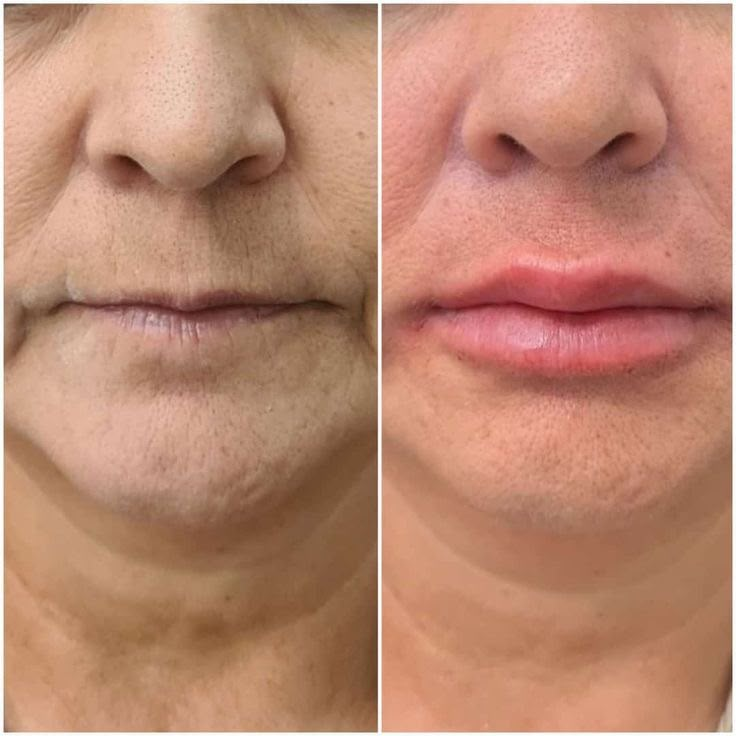 Preenchimento Labial